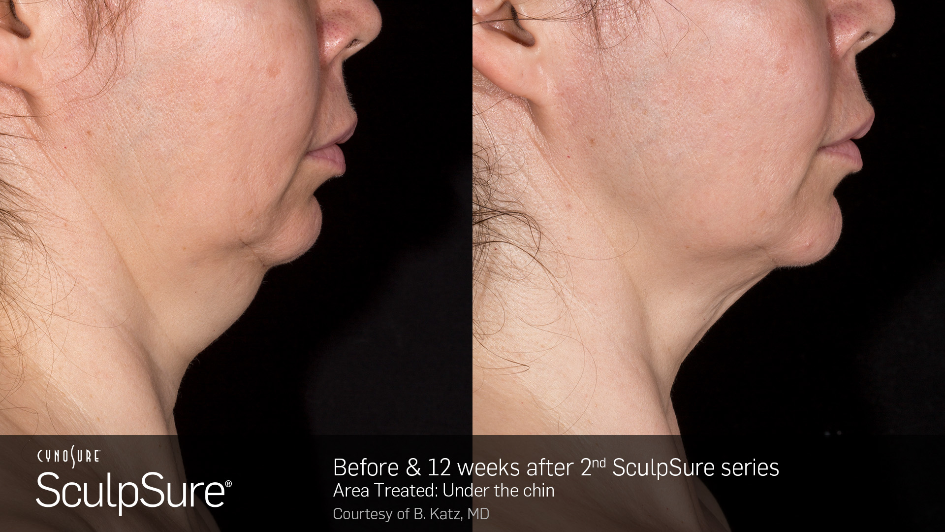 Before and after Sculpsure